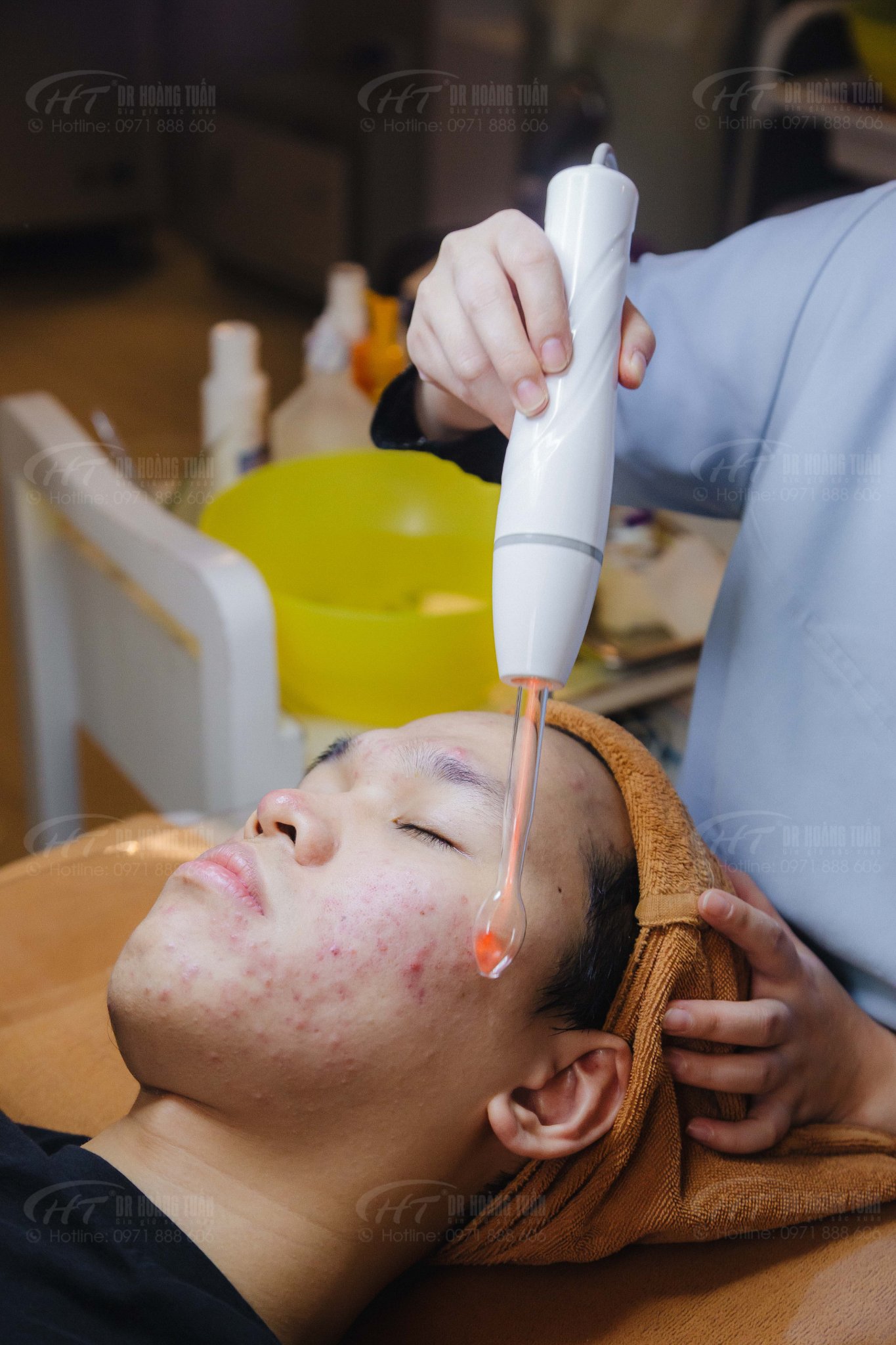 trị mụn bằng laser có tốt không